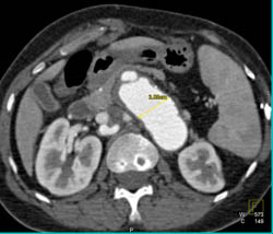 Aortic Aneurysm - CTisus CT Scan