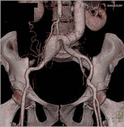 Aortic Aneurysm - CTisus CT Scan