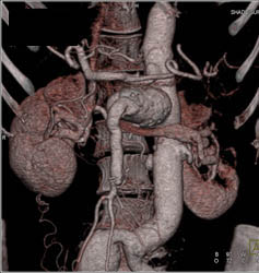 SMA Aneurysm in Loeys-Dietz Syndrome - CTisus CT Scan