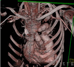 Aortic Aneurysm - CTisus CT Scan