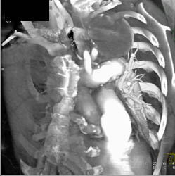 Aortic Aneurysm - CTisus CT Scan