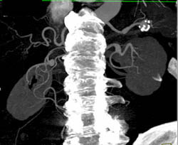 Splenic Artery Aneurysm - CTisus CT Scan