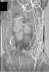 SVC Occlusion With Collaterals in Abdominal Wall - CTisus CT Scan