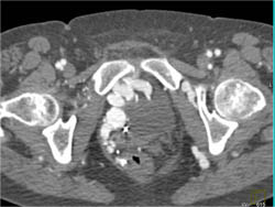 Large Pelvic Varices With Pelvic Arteriovenous Malformation (AVM) - CTisus CT Scan