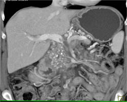 Portal Vein Thrombosis Due to Chronic Pancreatitis - CTisus CT Scan