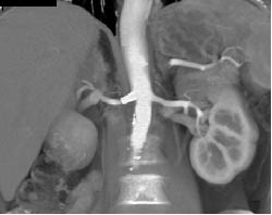 Patent Stent in Renal Artery - CTisus CT Scan