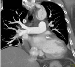 Type A Dissection - CTisus CT Scan