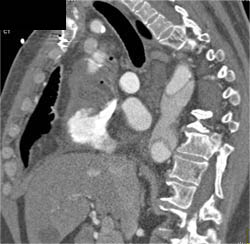 Type A Dissection - CTisus CT Scan