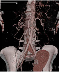 Collaterals Due to Vascular Bypasses - CTisus CT Scan