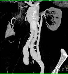 Bypass From Iliac Artery to Left Renal Vein - CTisus CT Scan