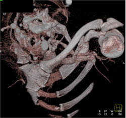 Patent Subclavian Stent - CTisus CT Scan