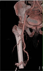 AKA (above-the-knee amputation) With CTA - CTisus CT Scan