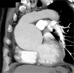 Dilated Aortic Root - CTisus CT Scan