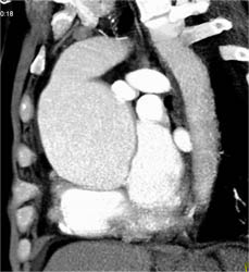 Dilated Aortic Root - CTisus CT Scan