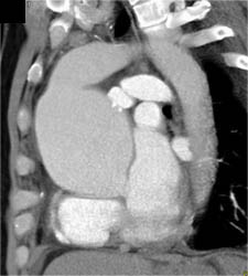 Dilated Aortic Root - CTisus CT Scan