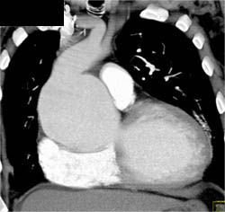 Dilated Aortic Root - CTisus CT Scan