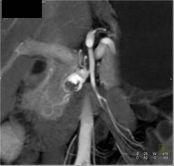 Hepatic Artery Aneurysm - CTisus CT Scan