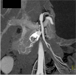 Hepatic Artery Aneurysm - CTisus CT Scan