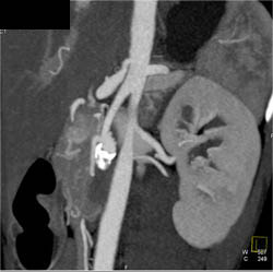 Hepatic Artery Aneurysm - CTisus CT Scan