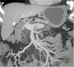 Partial Portal Vein (PV), Superior Mesenteric Vein (SMV) and Splenic Vein Thrombosis - CTisus CT Scan