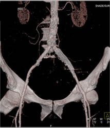 Patent Stent in Left Common Iliac Artery - CTisus CT Scan