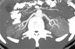 Polyarteritis Nodosa - CTisus CT Scan