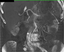 Hepatic Artery Aneurysm - CTisus CT Scan