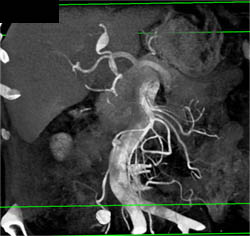 Hepatic Artery Aneurysm - CTisus CT Scan