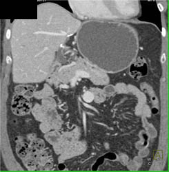 Venous Aneurysm - CTisus CT Scan