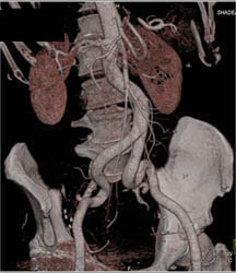 Ectatic Iliac Artery - CTisus CT Scan