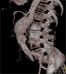 Abdominal Aortic Aneurysm (AAA) - CTisus CT Scan