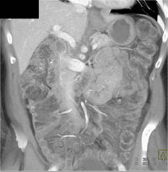 Dissection SMA - CTisus CT Scan