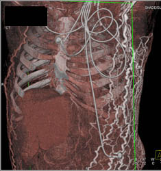 SVC Occlusion With Chest Wall Collaterals - CTisus CT Scan