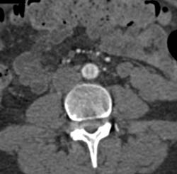 Pseudo-dissection Due to Unusual Artifact - CTisus CT Scan