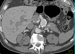 Hepatic Artery Aneurysm - CTisus CT Scan