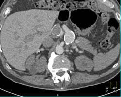 Hepatic Artery Aneurysm - CTisus CT Scan