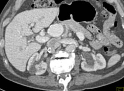 Hepatic Artery Aneurysm - CTisus CT Scan