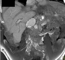 Hepatic Artery Aneurysm - CTisus CT Scan