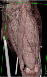 Femur Fracture W/o Vascular Injury - CTisus CT Scan