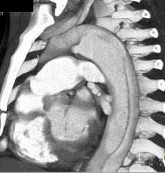 Type B Dissection - CTisus CT Scan