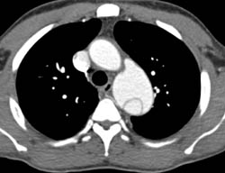 Type B Dissection - CTisus CT Scan