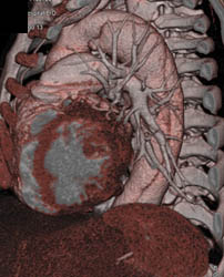 Type B Dissection - CTisus CT Scan