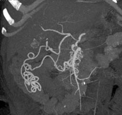 Median Arcuate Ligament Syndrome- See Celiac Artery - CTisus CT Scan