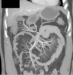 Mesenteric Arcade - CTisus CT Scan