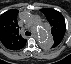 Stent in Arch Aneurysm With Large Endoleak - CTisus CT Scan