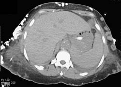 Aortic Occlusion With Huge Collaterals - CTisus CT Scan