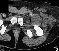 Pseudoaneurysm in Groin With Bleed - CTisus CT Scan