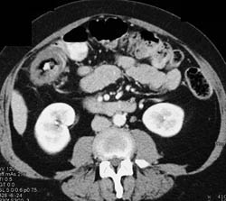 Ischemic Colitis - Cecum - CTisus CT Scan