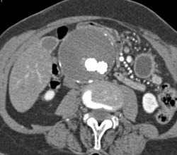 High Density Structure Simulates An Endoleak - CTisus CT Scan