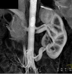 Nice Example of Renal Vein Surrounding Renal Artery and How It Differs on VRT and MIP Images - CTisus CT Scan